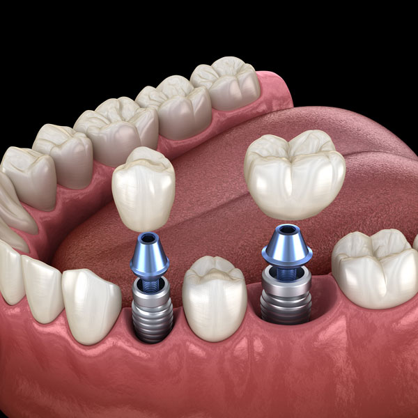 dental implants graphic